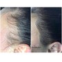 Hair Restoration