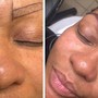 Chemical peel