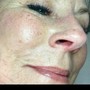 Celluma LED add on to facial