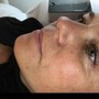 Celluma LED add on to facial