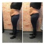 Meso Lipo injections (needless fat dissolve injections)