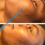 Chemical peels