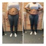 Meso Lipo injections (needless fat dissolve injections)