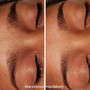 Men Brazilian/Nano needling Brojacial