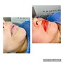 BB Extraction ONLY Facial