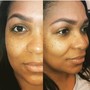 MicroNeedling