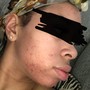 Acne Facial