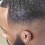 Hairline restoration