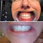 Laser Teeth Whitening