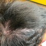 Scalp Treatment