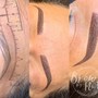 CHIN LIFT  + RF SKIN TIGHTENING