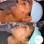 Acne Facial w/enzyme peel