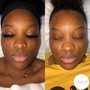 Acne Facial w/enzyme peel