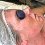 Facial Cupping