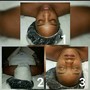 Teen Acne Facial