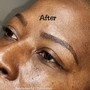 Chemical peel