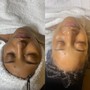 Dermaplaning And Enzyme Peel