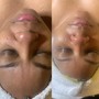 Dermaplaning And Enzyme Peel