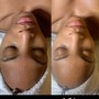 Add On Buttock Facial