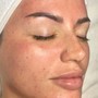 Acne Facial