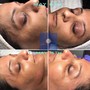 Dermaplaning  facial