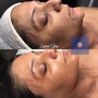 Dermaplaning with a super facial Peel