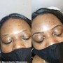 Microdermabrasion