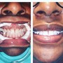 1 Hour Session Teeth Whitening 60 Min