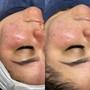 Vellus Exfoliation Add-On