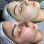 Vellus Exfoliation Add-On