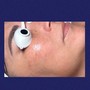 Add-on Microdermabrasion