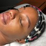 Microdermabrasion Facial