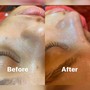 Dermaplaning Facial