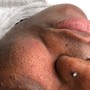 MicroNeedling