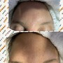 Glycolic Peel