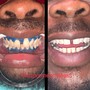 1 Hour Session Teeth Whitening 60 Min