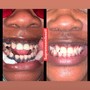 1 Hour Session Teeth Whitening 60 Min