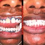 1 Hour Session Teeth Whitening 60 Min