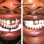 1 Hour Session Teeth Whitening 60 Min