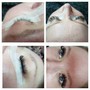 Dark Spot Removal