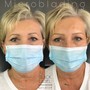 MicroNeedling *add LED therapy for $25