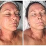 Facial Cupping