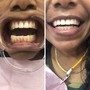 Teeth Whitening