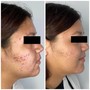 Microdermabrasion