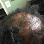 Scalp Therapy Treatment