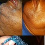 Microdermabrasion