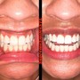 1 Hour Session Teeth Whitening 60 Min