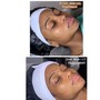 Dermaplaning