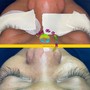 AcneTreatment Facial