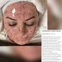 Dermaplaning facial